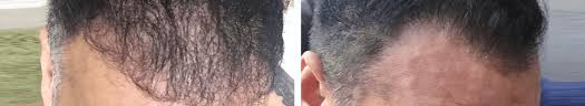 Harikiran chekuri, an expert hair transplant surgeon. Best Hair Regrowth Clinics In Hyderabad Hair Regrowth Treatment
