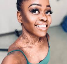 Vitiligo Voices