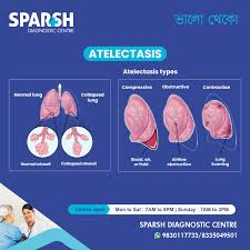 Image result for Atelectasis