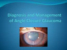 Aacg affects 4 in 1000 people aged over 40 years old and can cause. Ppt Diagnosis And Management Of Angle Closure Glaucoma Powerpoint Presentation Id 5401465