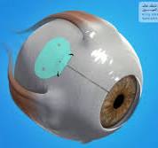 ‫زراعة الأنبوب لتخفيف ضغط العين Tube Surgery – بوابة التثقيف ...‬‎