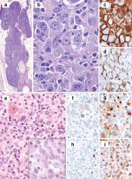 Niche suggesting a common cell of origin with disease evolution overlapping with related anterior mediastinal lymphomas. Gray Zones Around Diffuse Large B Cell Lymphoma Conclusions Based On The Workshop Of The Xiv Meeting Of The European Association For Hematopathology And The Society Of Hematopathology In Bordeaux France