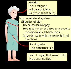 Image result for Polymyalgia Rheumatica