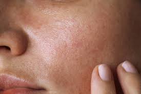 Image result for contact dermatitis