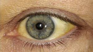 Penyakit kuning adalah gejala dan tanda dari penyakit tertentu, sedangkan hepatitis a adalah penyakit. 8 Gejala Penyakit Kuning Pada Orang Dewasa Kenali Penyebabnya Hot Liputan6 Com