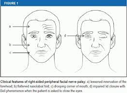 After examination by a doctor and with proper. The Diagnosis And Treatment Of Idiopathic Facial Paresis Bell S Palsy 11 10 2019