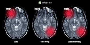 Image result for Brain Contusion