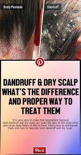 It Is Very Easy To Make That Assumption Because Both Dandruff And Dry Scalp Can Make The Skin On The Scalp I Dry Scalp Remedy Dry Scalp Treatment Diy Dry Scalp