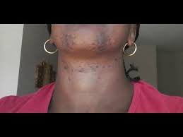 Ingrown hairs are a pesky skin problem that occur after shaving, plucking, tweezing, threading, or waxing hair. Pin By Diane Dunlap On Blk Skin Care In 2021 Coarse Hair Ingrown Hair Short Hair Styles