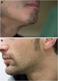Facial hair transplants work the same way as the more common scalp hair transplant. Figure 1 Alopecia Areata Of The Beard A Review Of The Literature Springerlink