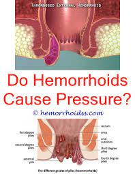 Pin On What Causes Hemorrhoids