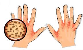 يمكن لهذا السوس إذا بقي من دون علاج أن يعيش على الجلد. Ø¹Ù„Ø§Ø¬ Ø§Ù„Ø¬Ø±Ø¨ Scabies Ø·Ø¨ÙŠØ¨ Ø¯ÙˆØª ÙƒÙˆÙ…