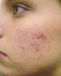 There are currently 81 laser hair removal + acne questions and doctor answers on realself. Before After Laser Acne Treatment Before After Seduire London Laser Hair Removal Beauty Treatments In Soho London