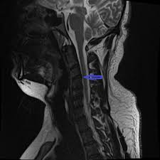 Some, like neuromyelitis optica, adem, optic neuritis, and transverse myelitis, are believed to be autoimmune, indirectly damaging the myelin sheath as a result of an abnormal immune assault. Cureus A Rare Case Of Acute Transverse Myelitis Atm And Acute Motor And Sensory Axonal Neuropathy Amsan Overlap
