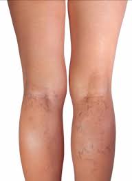 Varicose Veins Treatment I Natural At Home Remedies I Horse Chestnut Essential Oils Compression Isabella S Clearly