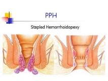 What is a Grade 4 hemorrhoid?