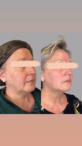 FACIAL OPTIMIZATION ⚖️💉⚖️, 👇, CONSERVATIVE❤️TASTEFUL❤️YOU, 👇, To see:,  👩🏼‍⚕️Dawn Naylor NP-BC, DNP, CANS @skinesteemmedspa , 👩🏼‍⚕️Lindsay  Trudeau RN,BSN,FNP-BC, CANS @lindsaynp_skinesteem, 👩🏼‍⚕️Holly ...