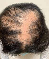 Excessive itching can damage hair follicles and hair shafts which can be detrimental to those who are already prone to thinning hair.2. An 11 Year Old Female With A 3 Year History Of Alopecia Mdedge Pediatrics