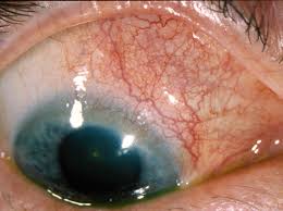 Image result for Scleritis