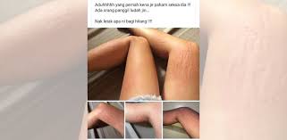 Apa ubat yang sesuai untuk kulit gatal saya. Punca Ludah Jin Sebab Gatal Merenyam Yang Perlu Kita Tahu Ini Ubat Dan Petua Boleh Dicuba