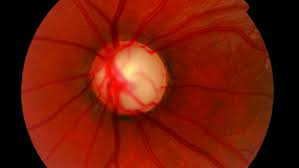 Glaucoma is a group of eye diseases which result in damage to the optic nerve (or retina) and cause vision loss. Congenital Glaucoma Symptoms And Treatments Imo