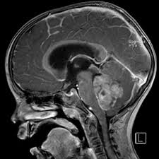 If you think you may have a tumor, talk to your. Saarland University Medical Center Brain Tumors In Children
