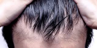 In a study by beehner conducted to compare the results of fue and fut, the survival rate of fus by fut was 86% as compared to 61.4% by fue afte. Best Fue Hair Transplant In Kuala Lumpur Malaysia