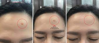 Em này không chỉ lấy đi lớp bụi bẩn, bã nhờn của da, mà còn giúp việc tẩy trang dễ dàng hơn bao giờ hết. Review Get Clearer Skin In Two Weeks With New And Improved Eucerin Proacne Solution A I Clearing Treatment Angie Tangerine