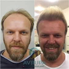 We did not find results for: Hair Transplant Before And After 15 Real Cases Clinic Advisor