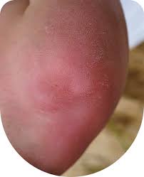 Image result for Lipodermatosclerosis