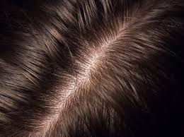 Juckende Kopfhaut Diese Hausmittel Verschaffen Linderung Juckende Kopfhaut Hausmittel Kopfhautjucken