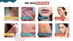 Image result for Dry Skin Management