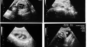 Pernah gak mendengar istilah ini? Ultrasound During Pregnancy How It S Done And What You Learn Babycenter