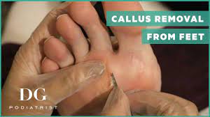Get as much nutrition as possible through food and drink. Callus Removal From Feet Small Seed Corn Youtube