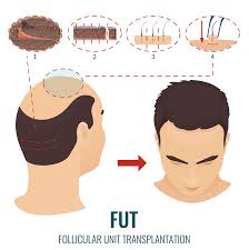 Zunächst ist sie sehr schonend für die kopfhaut, da hier kein skalpell zum einsatz kommt. Haartransplantation Wie Viva Aesthetic Hair Facebook