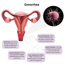 Image result for gonorrhea symptoms