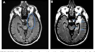 Contrast enhancement is uncommon during the first week of the disease. Mri Diagnosis Of Herpes Simplex Encephalitis In An Elderly Man With Nonspecific Symptoms Semantic Scholar