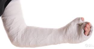 Image result for Long Arm Cast