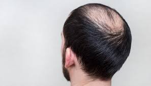 Dapatkan syampu terbaik untuk rambut gugur dan kelemumur. Kelemumur Rambut Gugur Merunsingkan