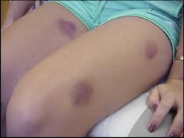 Dark colored lesions on hands, forearm, face & neck. References In A Puzzling Case Of Persistent Purpura The American Journal Of Medicine