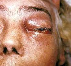 #india , que lucha por contener actualmente un brote de #covid19, ha detectado un incremento de casos de. Mucormycosis Wikipedia