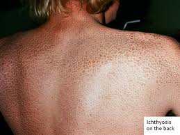 Image result for Ichthyosis