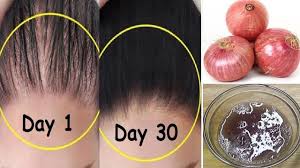 How To Grow Long Stop Hair Fall With Onion Egg Magical Hair Growth T Hair Growth Treatment How To Grow Natural Hair Treat Hair Loss