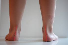 Wenn du nach innen gehst, findest du die quelle von freude. Der Kindliche Knick Senkfuss Kidfoot