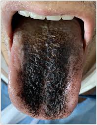 Image result for black tongue symptoms