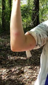 Image result for Fly Bite