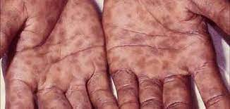 We did not find results for: Ø¹Ù„Ø§Ø¬ Ù…Ø±Ø¶ Ø§Ù„Ø²Ù‡Ø±ÙŠ Ø¨Ø§Ù„Ø£Ø¹Ø´Ø§Ø¨ Ù…Ù‚Ø§Ù„Ø§Øª