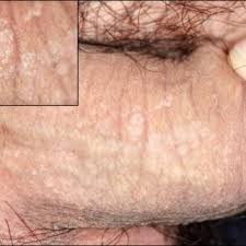 Image result for penis mycosis symptoms