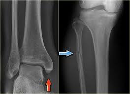 Der malleolus lateralis ist der äussere (=laterale) knöchel am sprunggelenk. The Radiology Assistant Special Cases Of Ankle Fractures