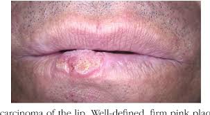 Because this common skin cancer can begin on any part of the body that has squamous cells, it can also develop inside does squamous cell carcinoma skin cancer hurt? Diagnosing Squamous Cell Carcinoma Of The Lip Using Dermoscopy Semantic Scholar